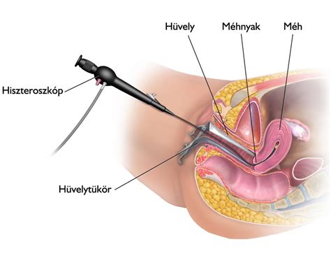 Hiszteroszkópia eljárás