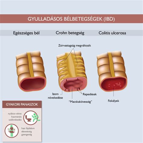A gyulladásos bélbetegségek típusai