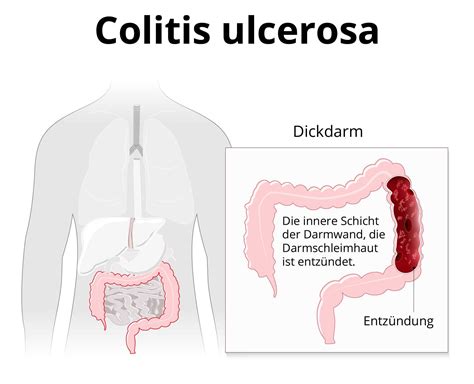 A Colitis Ulcerosa előfordulási gyakorisága életkor szerint