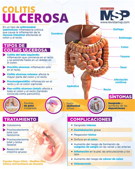 A Colitis Ulcerosa kezelési algoritmusa
