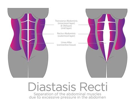 Rectus diastasis illusztráció