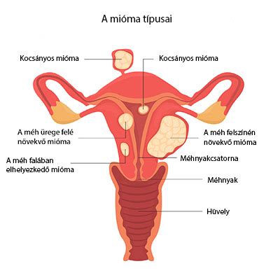 Mioma típusai és elhelyezkedése