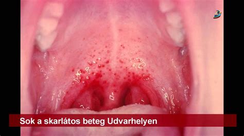 Skarlátos beteg torkának ábrázolása