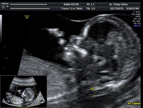 Magzati fejlődési rendellenességek felismerése ultrahangon