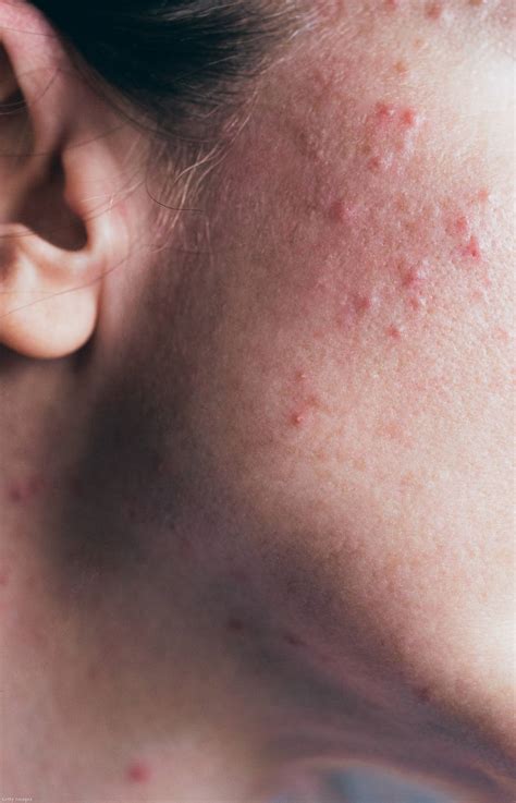 D-vitamin hiány tünetei gyermekeknél