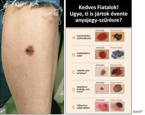 Bőrön található anyajegyek összehasonlítása (egészséges vs. gyanús)
