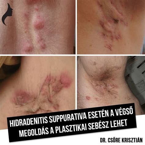 Váladékozó csecsemőszem