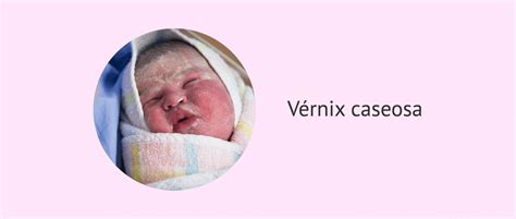 Magzatmáz (Vernix Caseosa)
