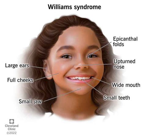 A Williams-szindróma arcvonásai