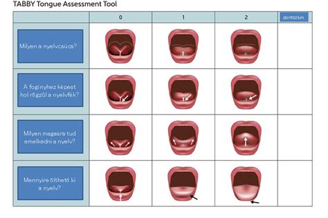 Illusztráció a lenőtt nyelv anatómiájáról