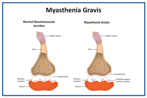 myasthenia gravis tünetei