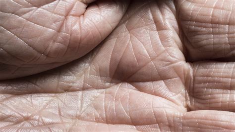 Az ichthyosis által érintett bőr
