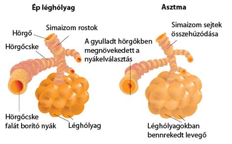 A hörgők gyulladása és beszűkülése asztmás roham során