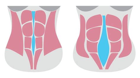 A szétnyílt hasizom és a hasleszorító használata