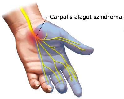 Carpalis alagút szindróma magyarázata