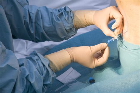 Epidurális érzéstelenítés beadása szülés közben