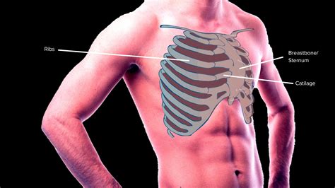 tyúkmellkas (pectus carinatum)