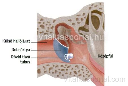 A dobhártya szakadása és a grommet tubus