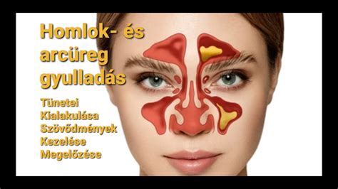 Illusztráció a tejcsatorna elzáródásáról és mellgyulladásról