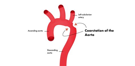 Coarctatio aortae kontrasztanyagos MRA vizsgálata