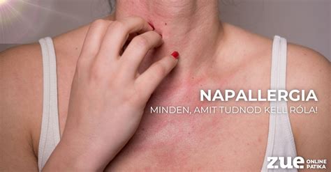 A napallergia kialakulásának mechanizmusa
