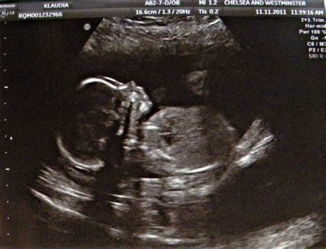 Üszögterhesség ultrahangképe