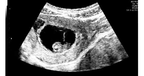 Ultrahangos kép ikrekről