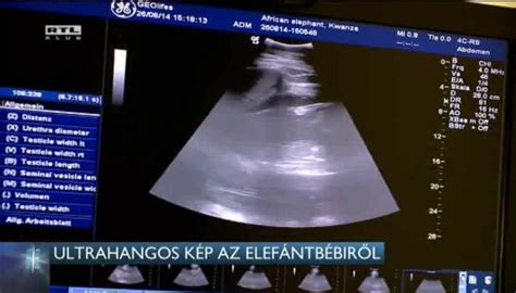 Ultrahangos kép a méhnyálkahártyáról