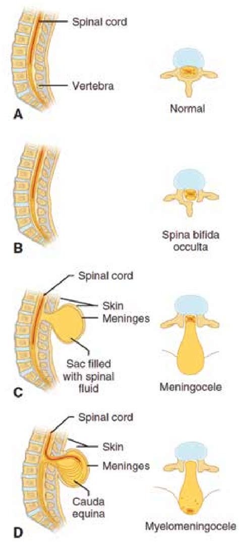 Nyitott gerinc típusai: occulta, meningocele, myelomeningocele