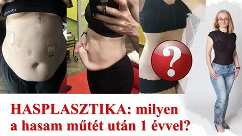 hasplasztika előtt és után
