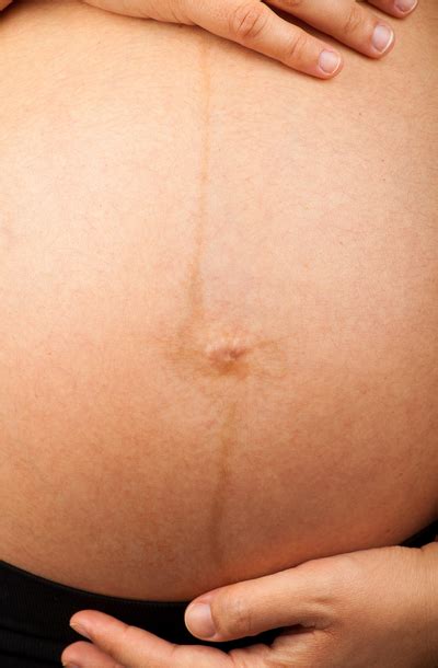 Linea nigra a terhes hasfalon