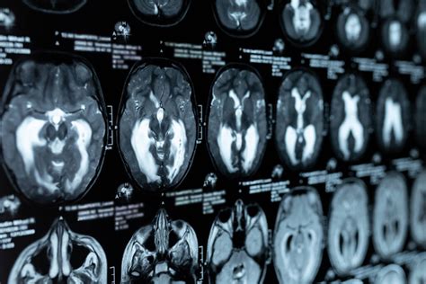 MRI felvétel a magzati agyról