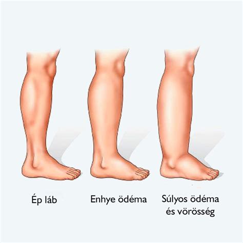 A mélyvénás trombózis megelőzése és tünetei