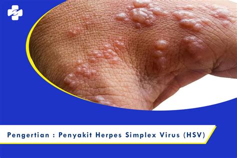 A herpes simplex vírus előfordulása életkor szerint