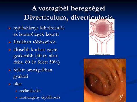 Vastagbél anatómia és betegségei