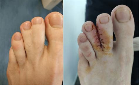 Ujjösszenövés (syndactyly) a kézen