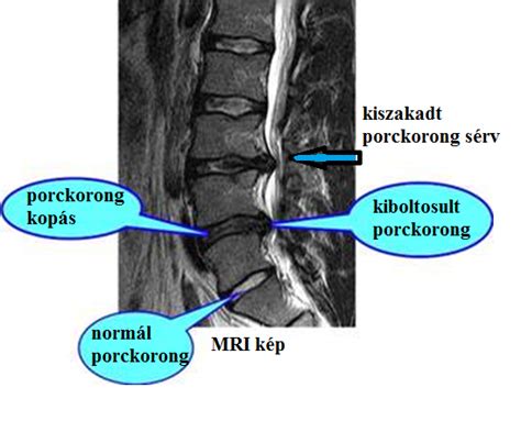 Porckorongsérv MRI felvétel