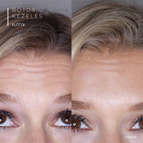 Botox kezelés