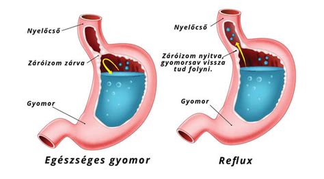 reflux tünetei és okai