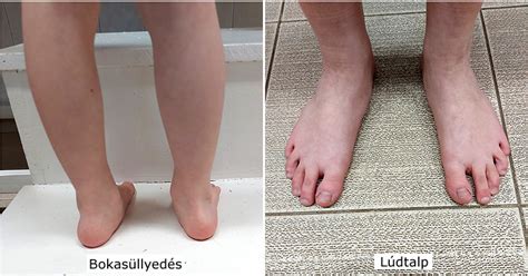 Különbség a lúdtalp és a bokasüllyedés között