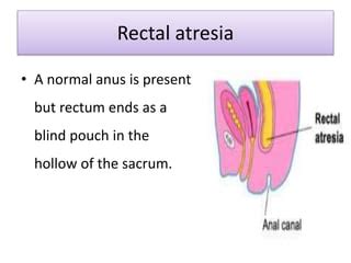 Anus atresia: veleszületett végbélnyílás hiánya