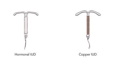 IUD (spirál) anatómiai elhelyezkedése a méhben