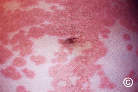 Herpes gestationis hólyagjai a bőrön