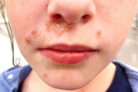 Impetigo herpetiformis tünetei