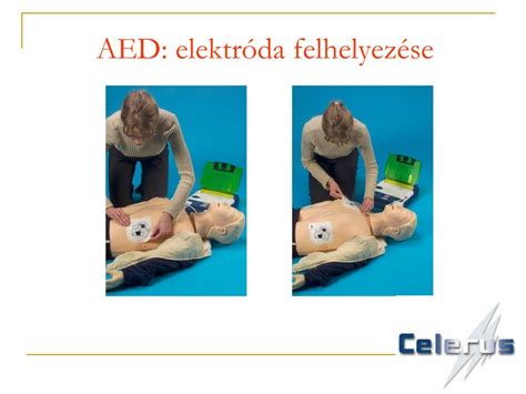 AED elektróda elhelyezése gyermeknél