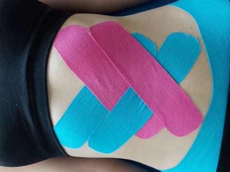 Diastasis recti és kinesio tape kezelés