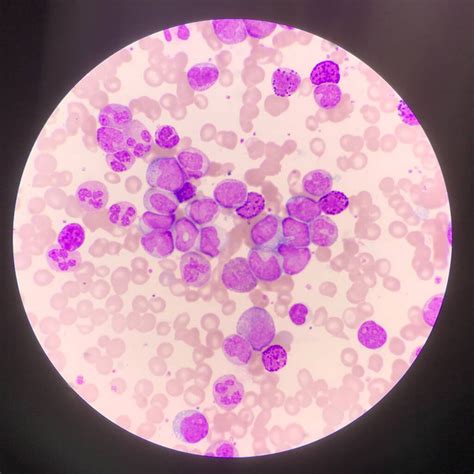 Génmutációk és leukémia