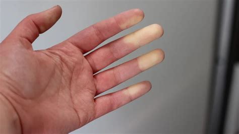 Raynaud-szindróma által érintett ujjak