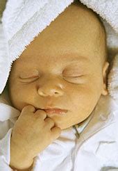 Újszülött sárgaság