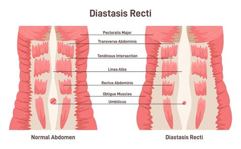 Szétnyílt hasizom (Diastasis Recti) ábra